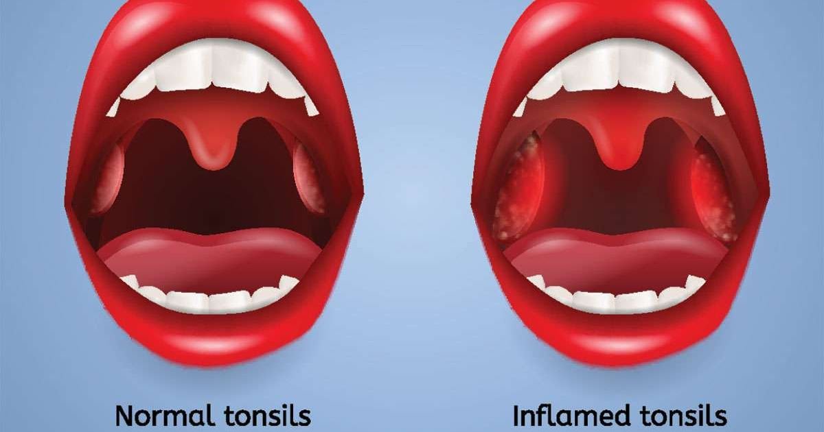 Can Tonsils Grow Back