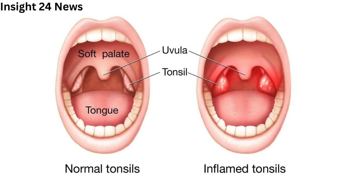 Can tonsils grow back after being removed? – tymoff